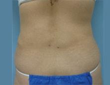 Vladimir Grigoryants, MD liposuction after — Glendale, CA