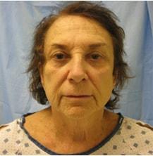 Deep Plane Facelift before at Vladimir Grigoryants, MD in Glendale, CA