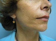 Deep Plane Facelift after at Vladimir Grigoryants, MD in Glendale, CA