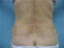 Vladimir Grigoryants, MD liposuction after — Glendale, CA