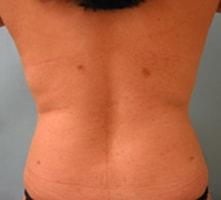 Vladimir Grigoryants, MD liposuction after — Glendale, CA