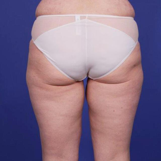 Arm Lift before at Wellspring Plastic Surgery in Austin, TX