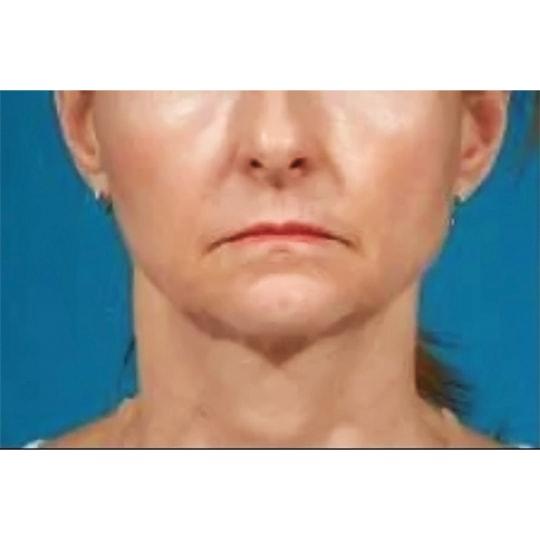 Facelift before at Wellspring Plastic Surgery in Austin, TX