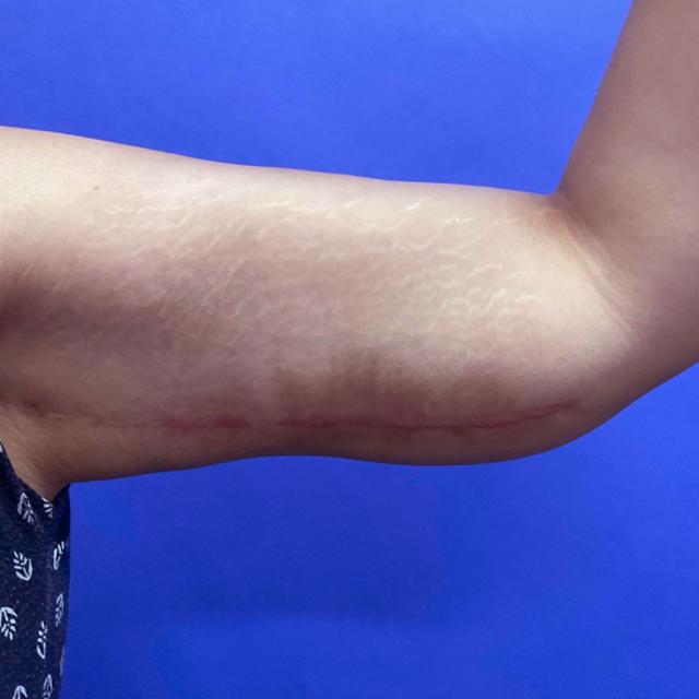 Arm Lift after at Wellspring Plastic Surgery in Austin, TX
