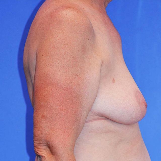 Breast Lift before at Wellspring Plastic Surgery in Austin, TX