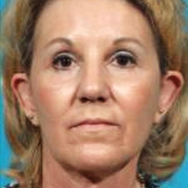Brow Lift after at Wellspring Plastic Surgery in Austin, TX
