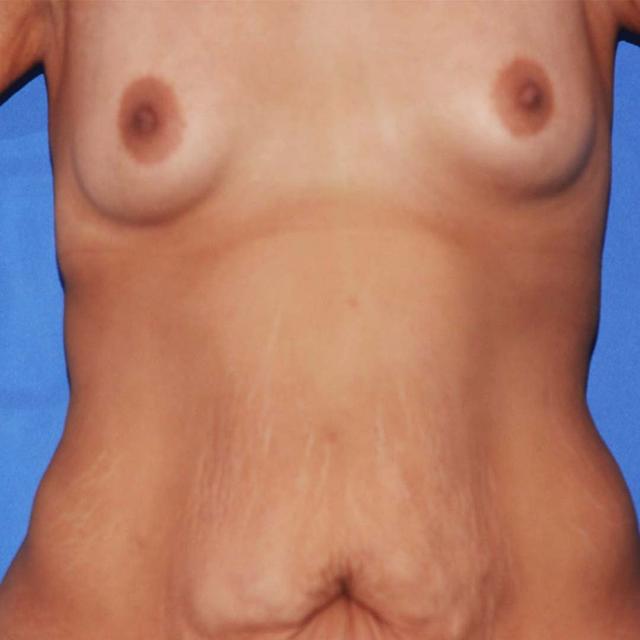 Mommy Makeover before at Wellspring Plastic Surgery in Austin, TX