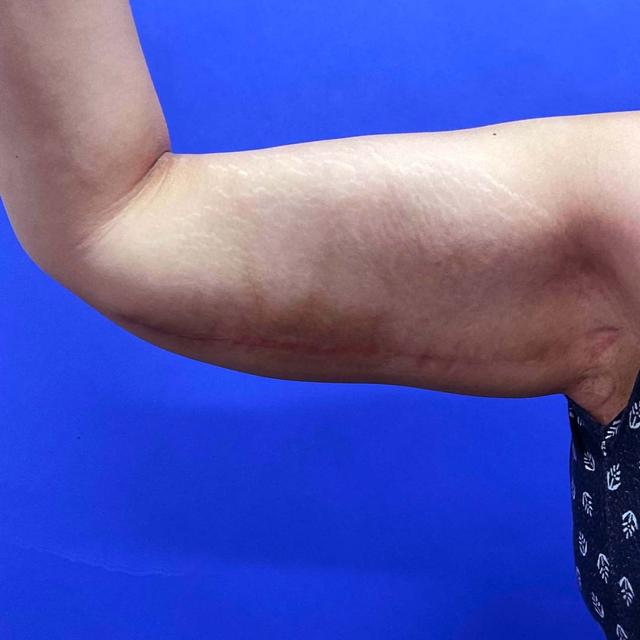 Arm Lift after at Wellspring Plastic Surgery in Austin, TX
