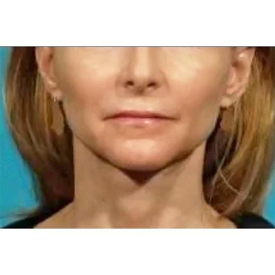 Facelift after at Wellspring Plastic Surgery in Austin, TX