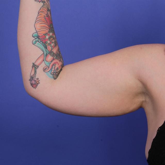 Arm Lift before at Wellspring Plastic Surgery in Austin, TX