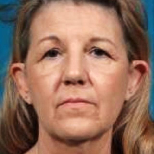 Brow Lift before at Wellspring Plastic Surgery in Austin, TX