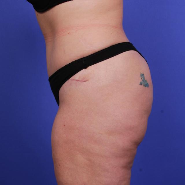 Tummy Tuck after at Wellspring Plastic Surgery in Austin, TX