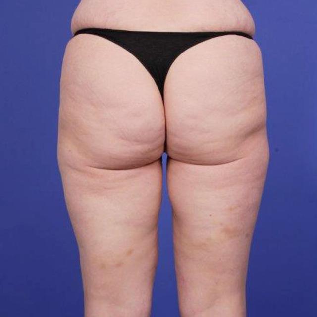 Arm Lift after at Wellspring Plastic Surgery in Austin, TX