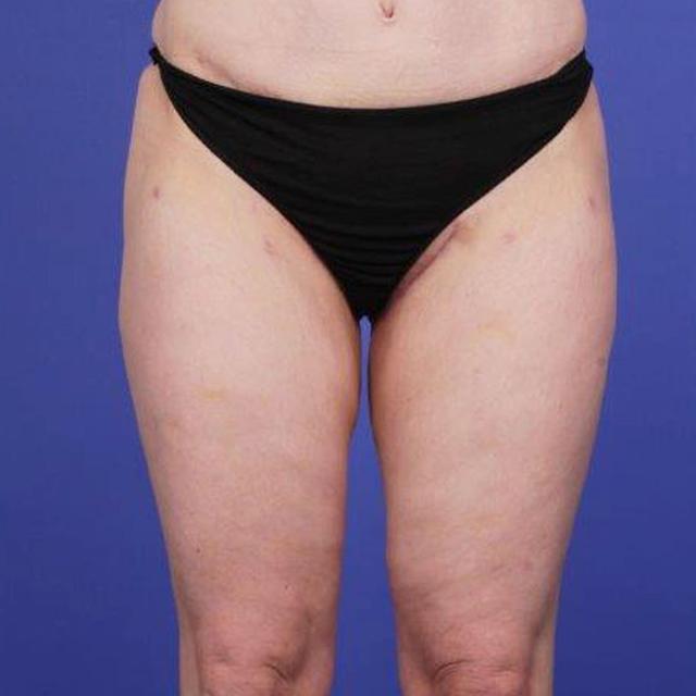 Arm Lift after at Wellspring Plastic Surgery in Austin, TX