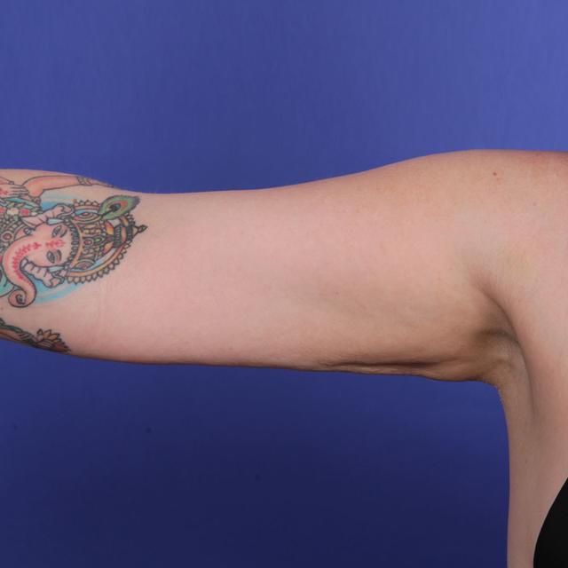 Arm Lift after at Wellspring Plastic Surgery in Austin, TX