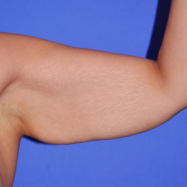 Arm Lift before at Wellspring Plastic Surgery in Austin, TX