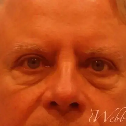 Blepharoplasty before at Webb Aesthetic Plastic Surgery & Med Spa in Murfreesboro, TN