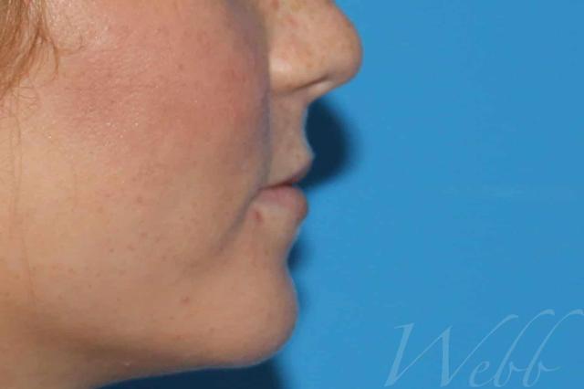 Juvederm before at Webb Aesthetic Plastic Surgery & Med Spa in Murfreesboro, TN