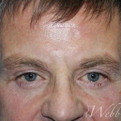 Blepharoplasty after at Webb Aesthetic Plastic Surgery & Med Spa in Murfreesboro, TN
