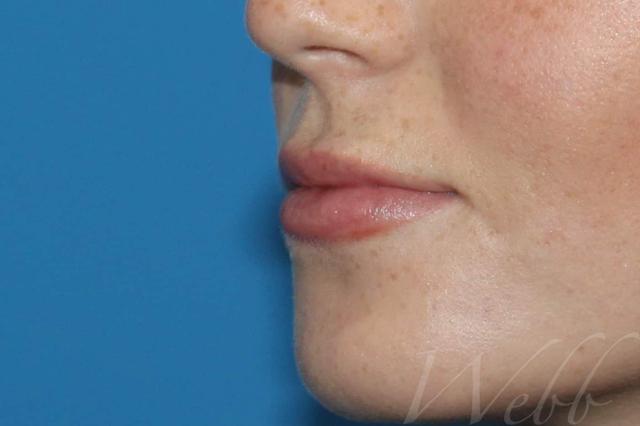 Juvederm after at Webb Aesthetic Plastic Surgery & Med Spa in Murfreesboro, TN