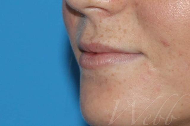 Juvederm before at Webb Aesthetic Plastic Surgery & Med Spa in Murfreesboro, TN
