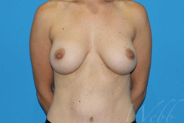 Mommy Makeover after at Webb Aesthetic Plastic Surgery & Med Spa in Murfreesboro, TN