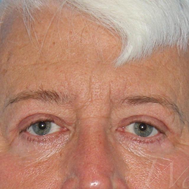 Blepharoplasty after at Webb Aesthetic Plastic Surgery & Med Spa in Murfreesboro, TN