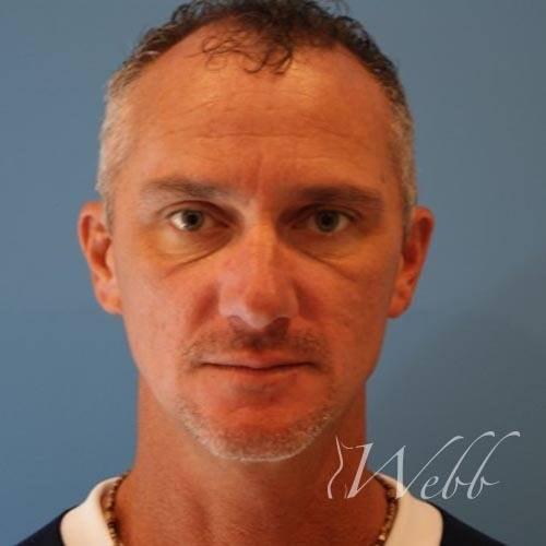 Mini Facelift before at Webb Aesthetic Plastic Surgery & Med Spa in Murfreesboro, TN