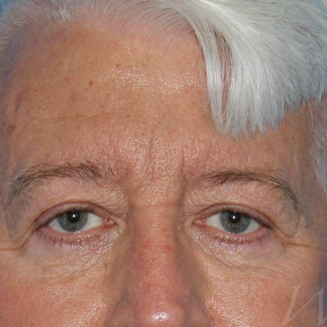 Blepharoplasty before at Webb Aesthetic Plastic Surgery & Med Spa in Murfreesboro, TN