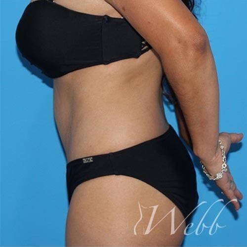Mommy Makeover after at Webb Aesthetic Plastic Surgery & Med Spa in Murfreesboro, TN