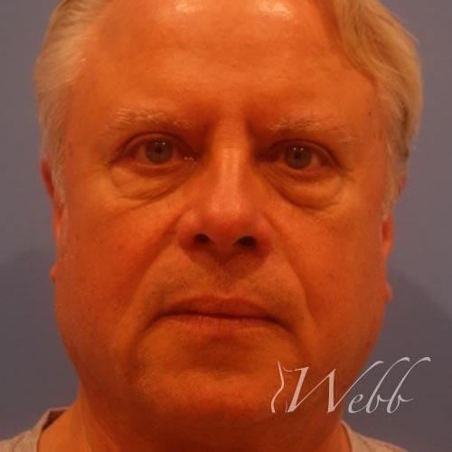 Mini Facelift before at Webb Aesthetic Plastic Surgery & Med Spa in Murfreesboro, TN