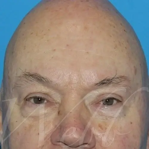 Blepharoplasty after at Webb Aesthetic Plastic Surgery & Med Spa in Murfreesboro, TN