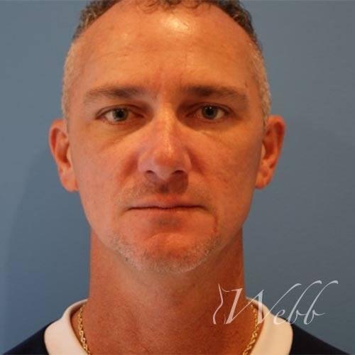 Webb Aesthetic Plastic Surgery & Med Spa facelift after — Murfreesboro, TN