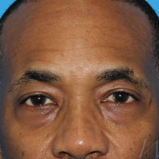 Blepharoplasty before at Webb Aesthetic Plastic Surgery & Med Spa in Murfreesboro, TN