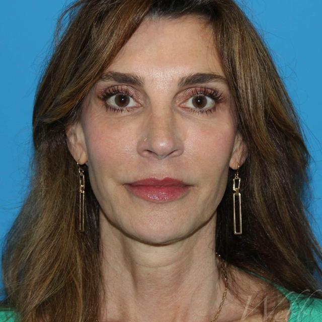 Morpheus8 after at Webb Aesthetic Plastic Surgery & Med Spa in Murfreesboro, TN