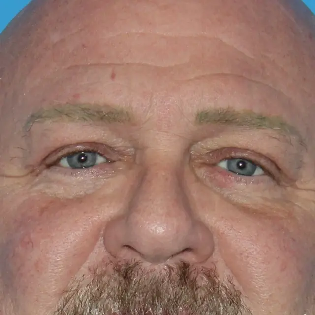 Blepharoplasty after at Webb Aesthetic Plastic Surgery & Med Spa in Murfreesboro, TN