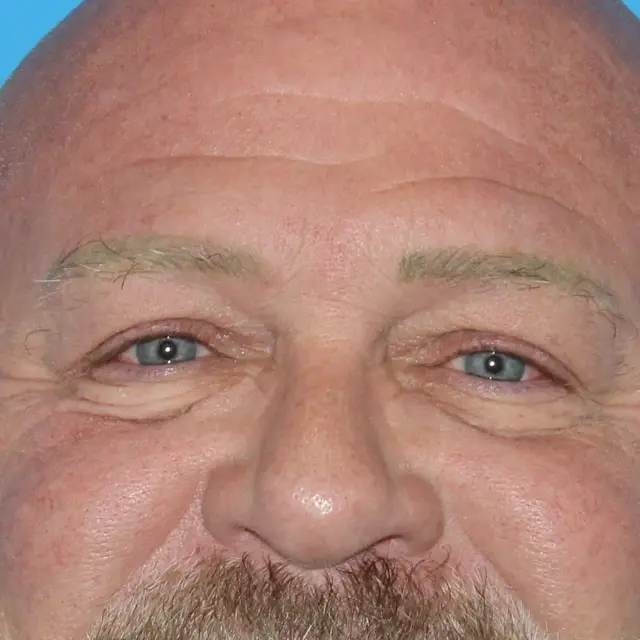 Blepharoplasty before at Webb Aesthetic Plastic Surgery & Med Spa in Murfreesboro, TN