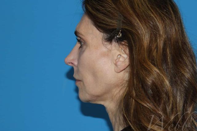 Morpheus8 before at Webb Aesthetic Plastic Surgery & Med Spa in Murfreesboro, TN