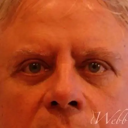 Blepharoplasty after at Webb Aesthetic Plastic Surgery & Med Spa in Murfreesboro, TN