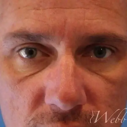 Blepharoplasty before at Webb Aesthetic Plastic Surgery & Med Spa in Murfreesboro, TN