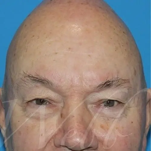 Blepharoplasty before at Webb Aesthetic Plastic Surgery & Med Spa in Murfreesboro, TN