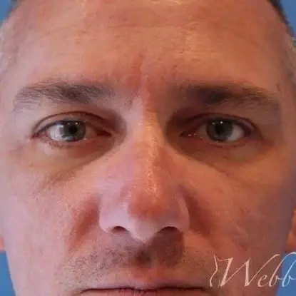 Webb Aesthetic Plastic Surgery & Med Spa eyelid lift after — Murfreesboro, TN