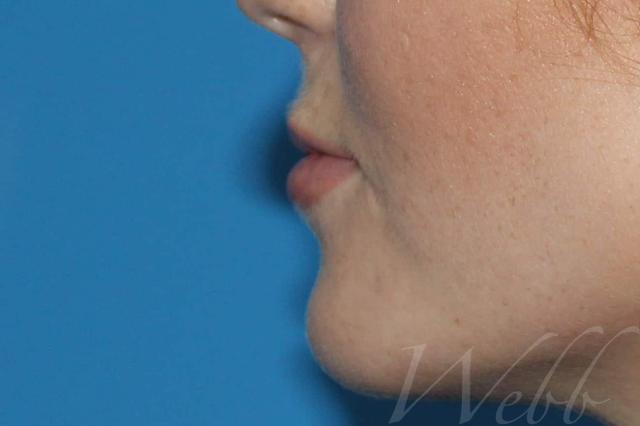Juvederm after at Webb Aesthetic Plastic Surgery & Med Spa in Murfreesboro, TN