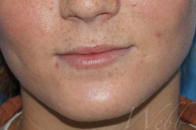 Juvederm before at Webb Aesthetic Plastic Surgery & Med Spa in Murfreesboro, TN