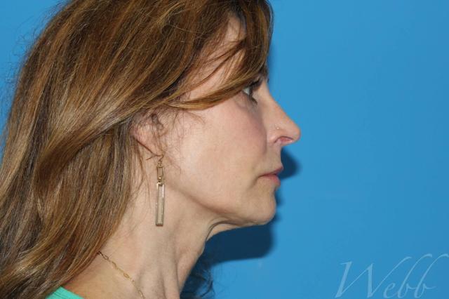 Morpheus8 after at Webb Aesthetic Plastic Surgery & Med Spa in Murfreesboro, TN