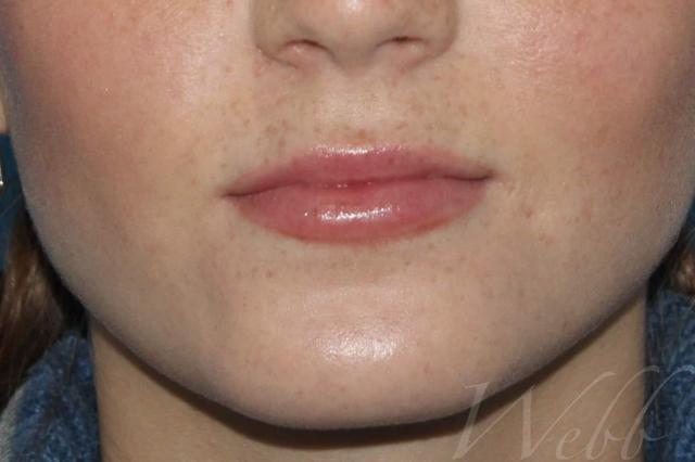 Juvederm after at Webb Aesthetic Plastic Surgery & Med Spa in Murfreesboro, TN