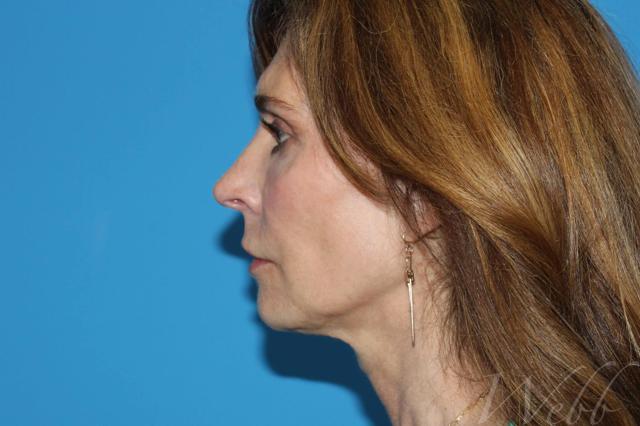 Morpheus8 after at Webb Aesthetic Plastic Surgery & Med Spa in Murfreesboro, TN