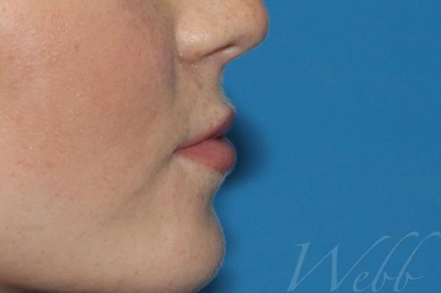 Juvederm after at Webb Aesthetic Plastic Surgery & Med Spa in Murfreesboro, TN