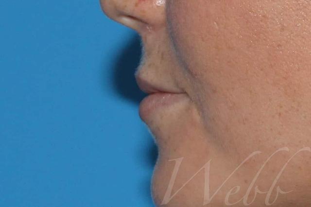 Juvederm before at Webb Aesthetic Plastic Surgery & Med Spa in Murfreesboro, TN