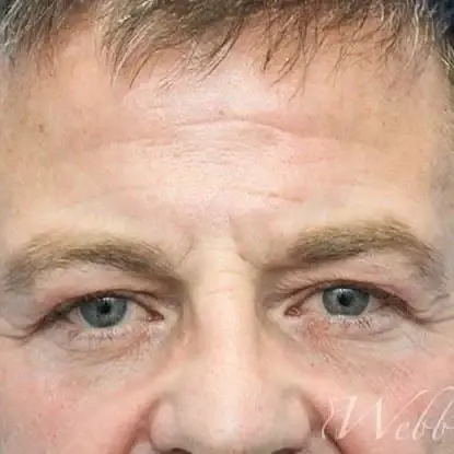 Blepharoplasty before at Webb Aesthetic Plastic Surgery & Med Spa in Murfreesboro, TN